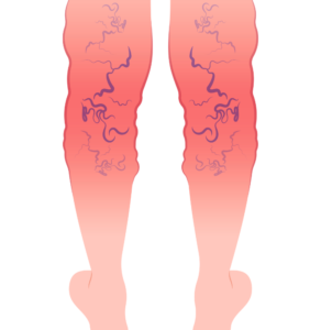 Varicose vein