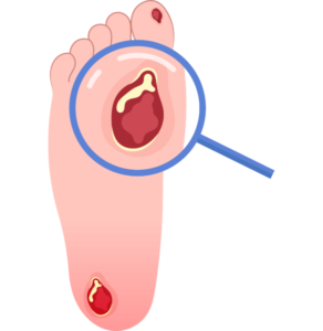 Diabetic foot
